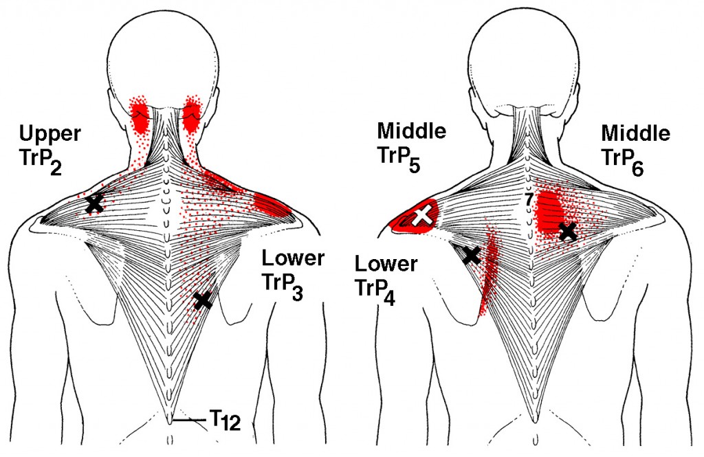 Burning Pain Between Your Spine And Shoulder Blade SIMPLE BACK PAIN 